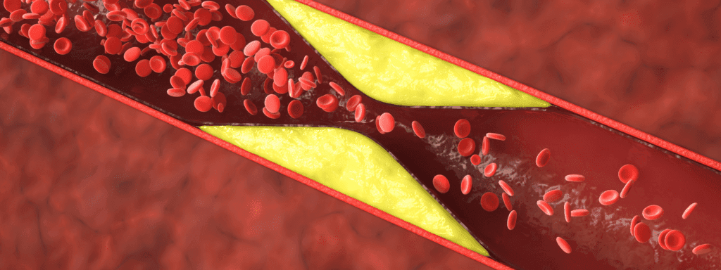 penyumbatan pembuluh darah penyebab penyakit jantung, stroke, serangan jantung
