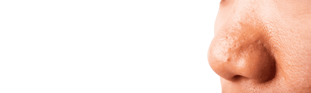 Cara Pakai Gold-G Bio Sea Cucumber untuk Jerawat di Hidung