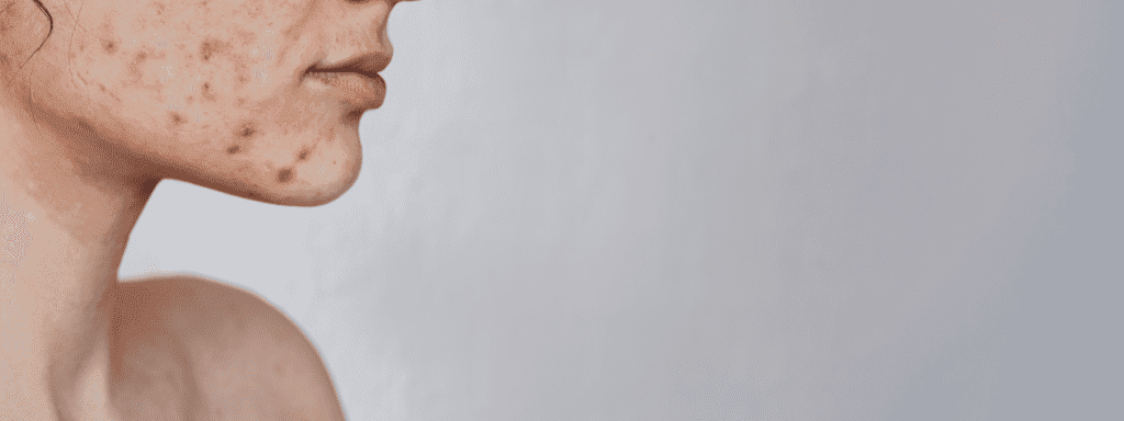 penyebab jerawat di dagu